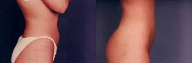 Brazilian Butt Lift result at Boris M. Ackerman, MD in Newport Beach, CA