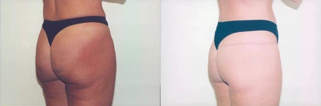 Brazilian Butt Lift result at Boris M. Ackerman, MD in Newport Beach, CA