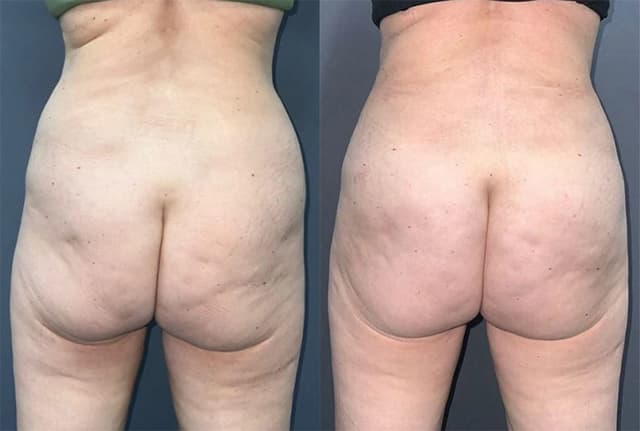 Brazilian Butt Lift result at Semira Bayati, MD, Plastic Surgery Boutique in Newport Beach, CA
