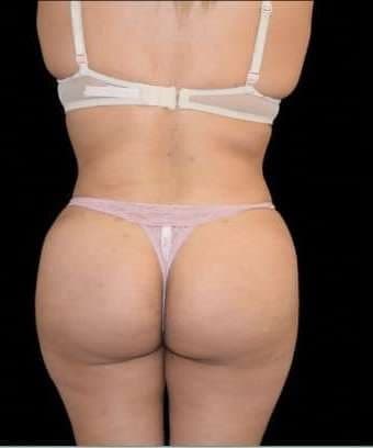 Brazilian Butt Lift after at Ali Roham, MD in Newport Beach, CA