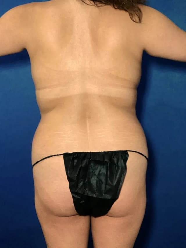 Brazilian Butt Lift before at Marguerite J. Bernett, MD in Newport Beach, CA