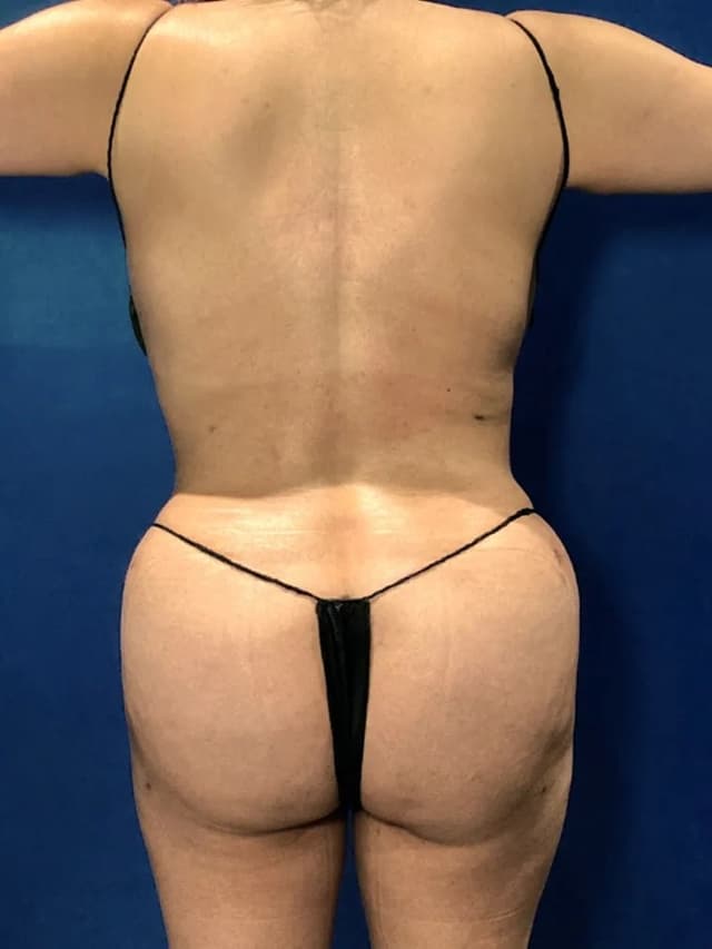 Brazilian Butt Lift after at Marguerite J. Bernett, MD in Newport Beach, CA