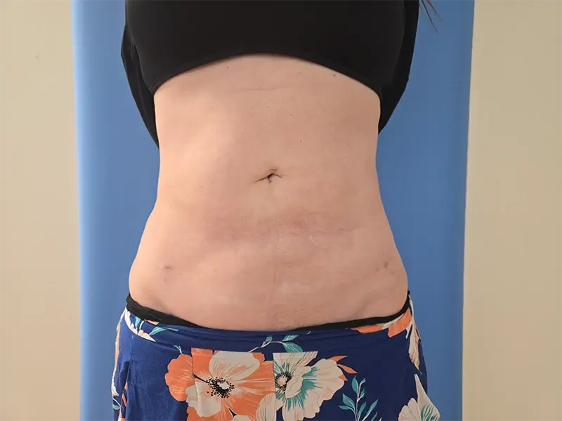 Avalon Lipo & Aesthetics - Carlsbad liposuction after — Carlsbad, CA