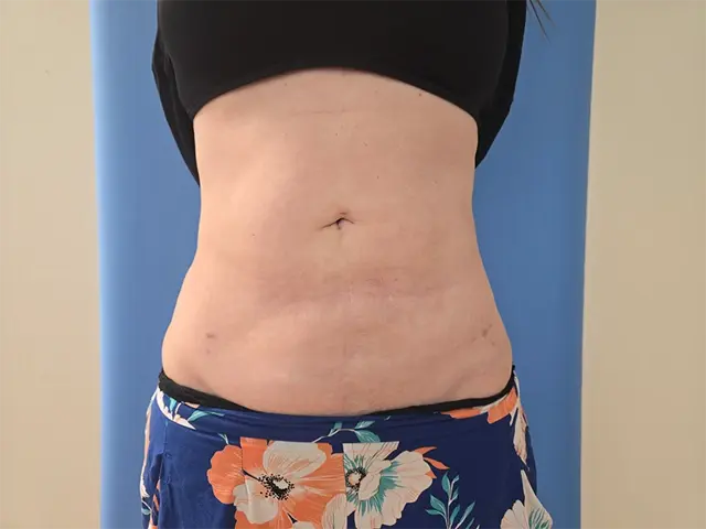 Liposuction after at Avalon Lipo & Aesthetics - Carlsbad in Carlsbad, CA