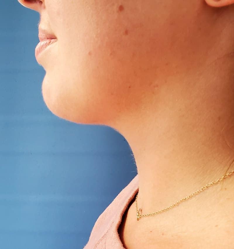 Avalon Lipo & Aesthetics - Carlsbad neck liposuction after — Carlsbad, CA