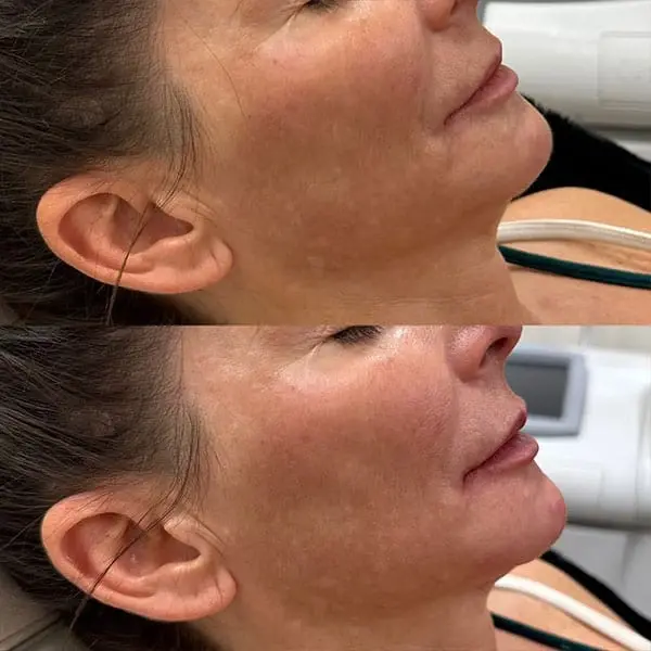 Jawline Filler result at MaVie Med Spa in St. George, UT