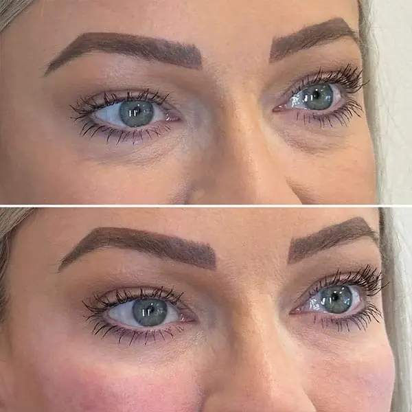 MaVie Med Spa undereye filler result — St. George, UT