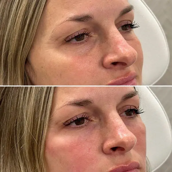 MaVie Med Spa undereye filler result — St. George, UT