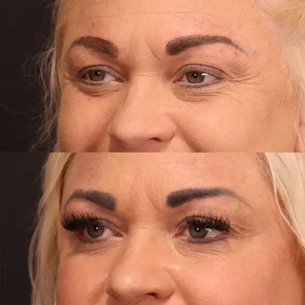 Botox result at MaVie Med Spa in St. George, UT