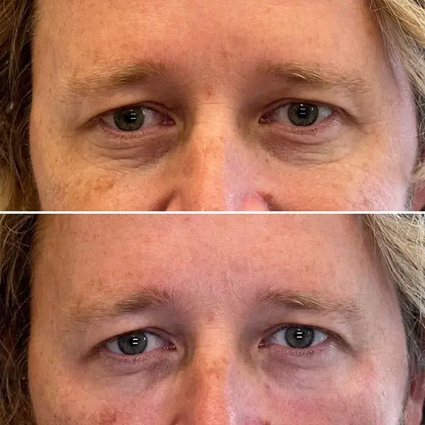 MaVie Med Spa undereye filler result — St. George, UT