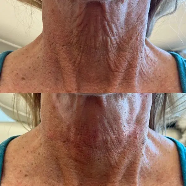 MaVie Med Spa skin tightening result — St. George, UT