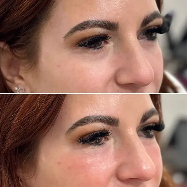 MaVie Med Spa undereye filler result — St. George, UT