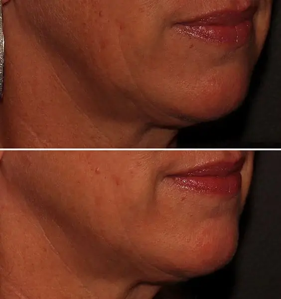 MaVie Med Spa skin tightening result — St. George, UT
