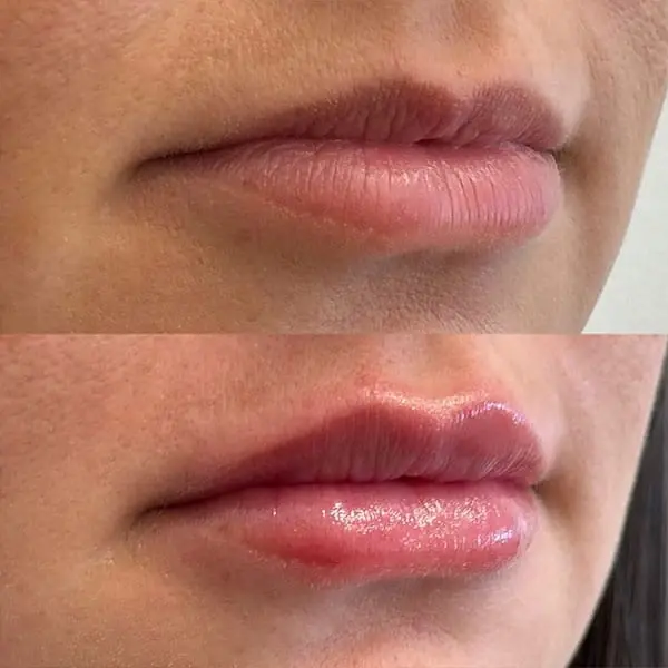 Lip Filler result at MaVie Med Spa in St. George, UT