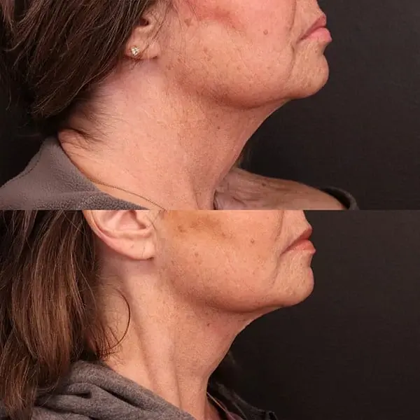 MaVie Med Spa skin tightening result — St. George, UT