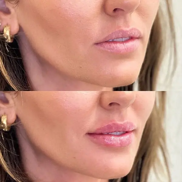 Lip Filler result at MaVie Med Spa in St. George, UT