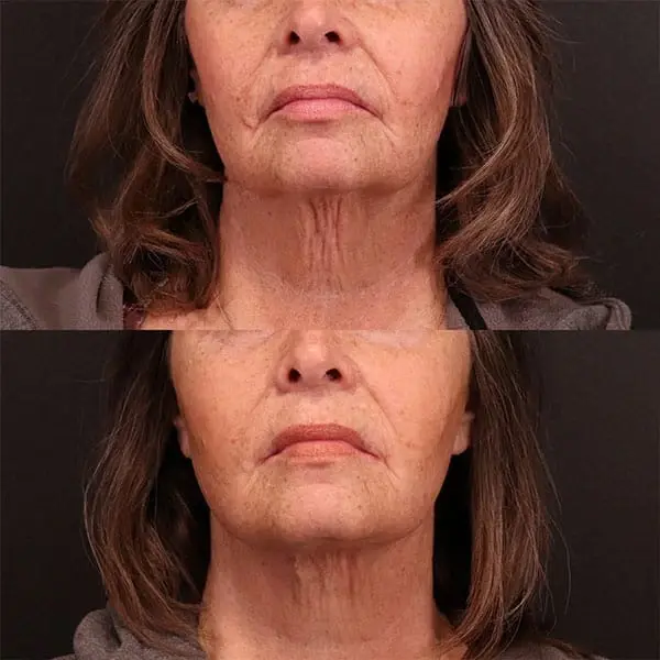 MaVie Med Spa skin tightening result — St. George, UT