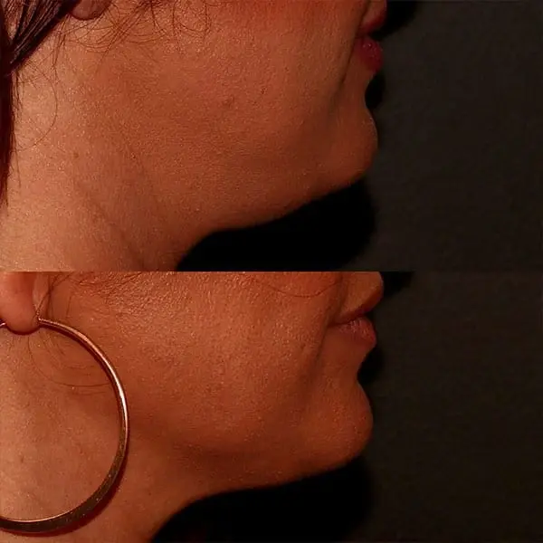 Kybella result at MaVie Med Spa in St. George, UT