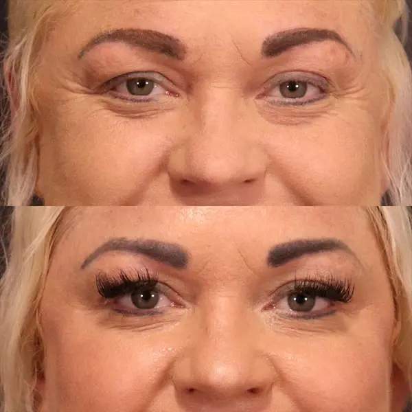 Botox result at MaVie Med Spa in St. George, UT
