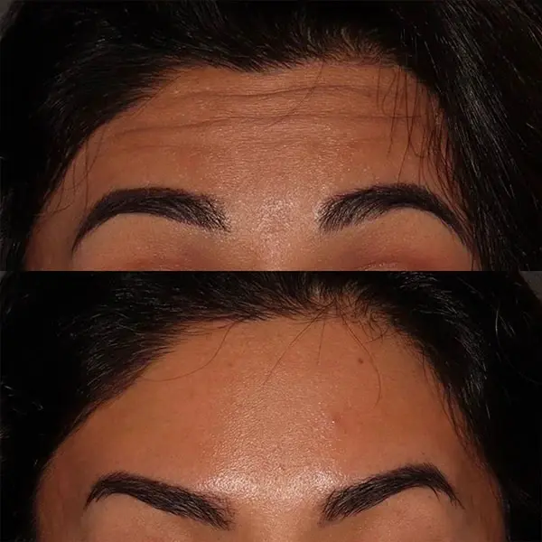 Botox result at MaVie Med Spa in St. George, UT