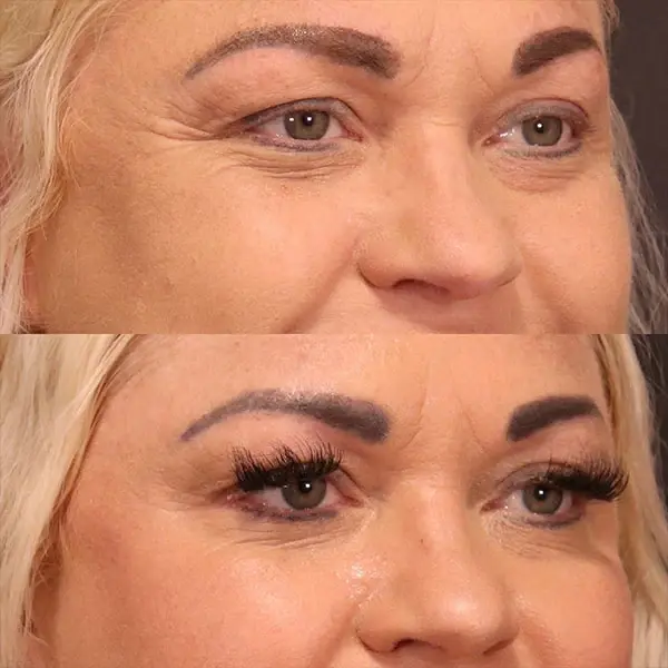 Botox result at MaVie Med Spa in St. George, UT