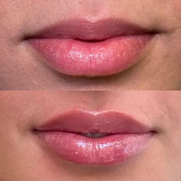 Lip Filler result at MaVie Med Spa in St. George, UT