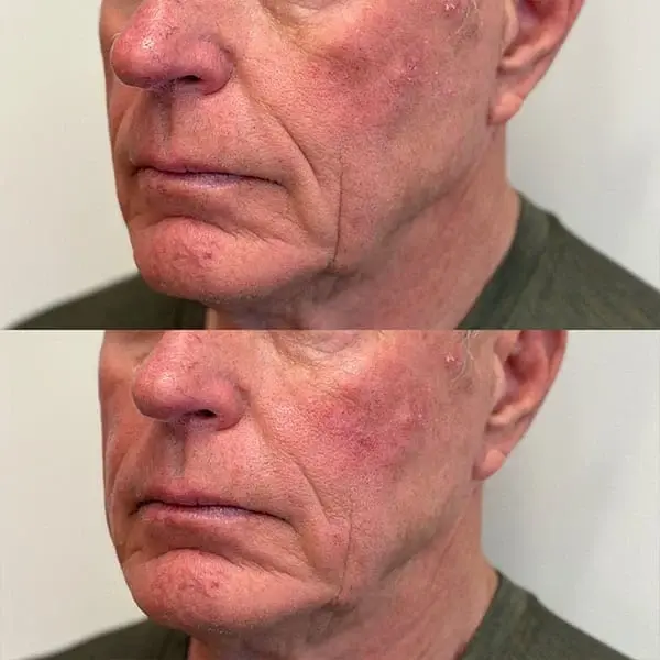 Dermal Fillers result at MaVie Med Spa in St. George, UT