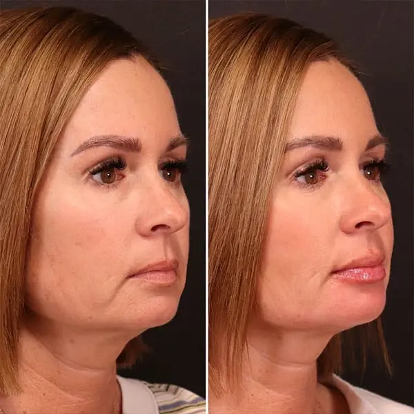 Jawline Filler result at MaVie Med Spa in St. George, UT