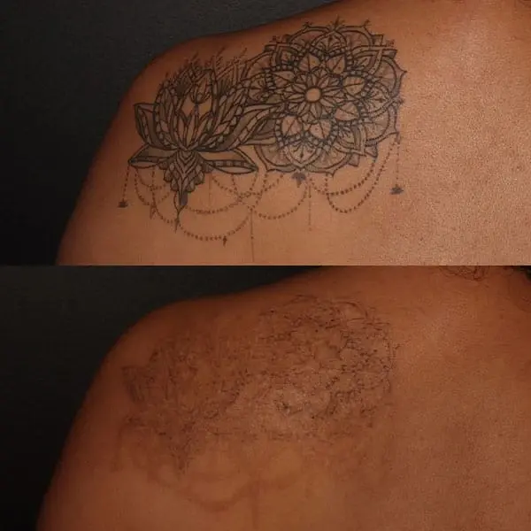 MaVie Med Spa laser treatment result — St. George, UT