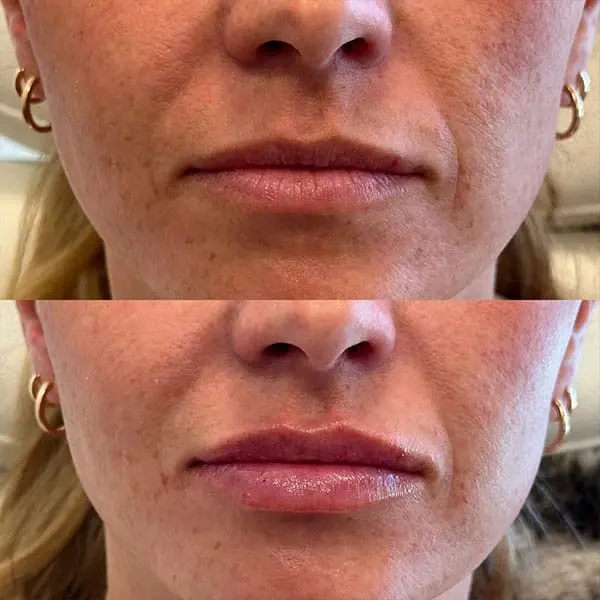 Lip Filler result at MaVie Med Spa in St. George, UT