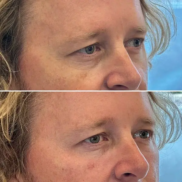 MaVie Med Spa undereye filler result — St. George, UT