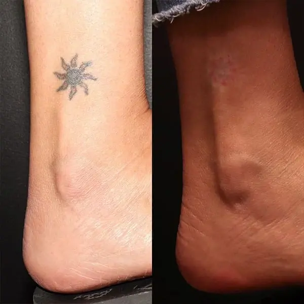 MaVie Med Spa laser treatment result — St. George, UT