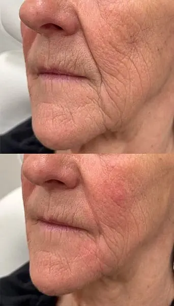Dermal Fillers result at MaVie Med Spa in St. George, UT