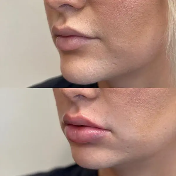 Lip Filler result at MaVie Med Spa in St. George, UT