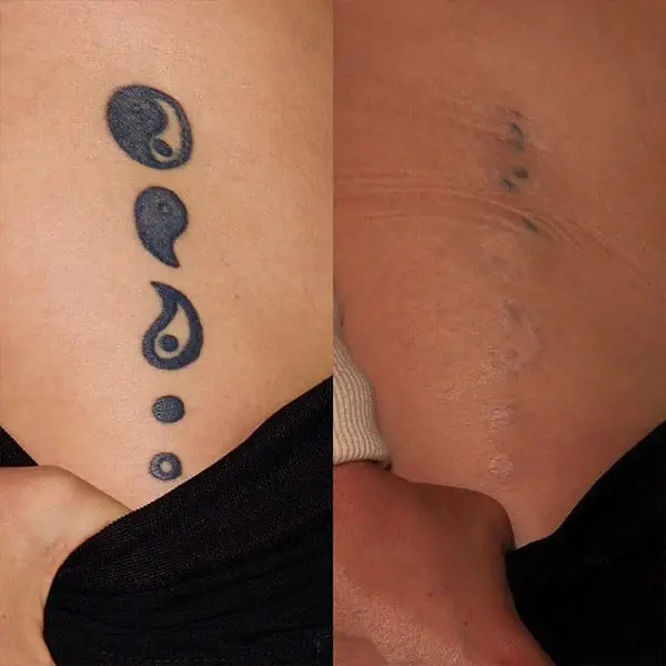 MaVie Med Spa laser treatment result — St. George, UT