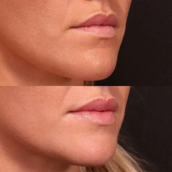 Lip Filler result at MaVie Med Spa in St. George, UT