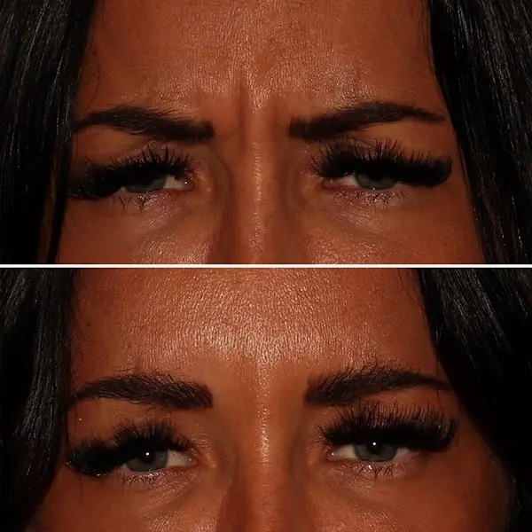 Botox result at MaVie Med Spa in St. George, UT