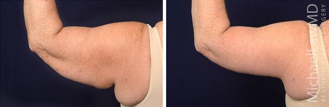Arm Lift result at Blue Water Plastic Surgery Partners in Raleigh, NC