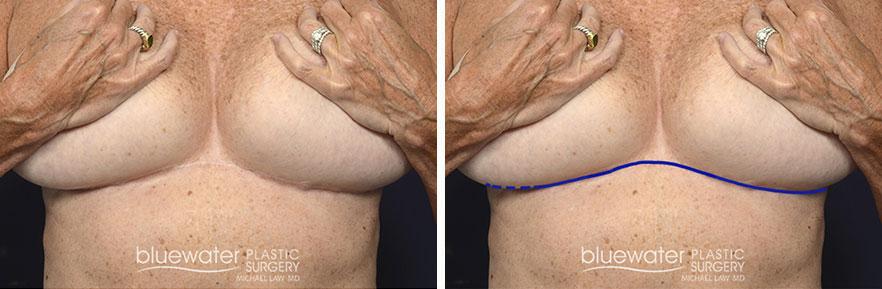 Blue Water Plastic Surgery Partners liposuction result — Raleigh, NC