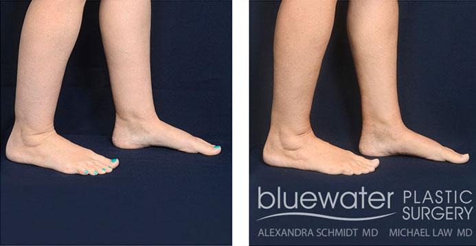 Blue Water Plastic Surgery Partners liposuction result — Raleigh, NC