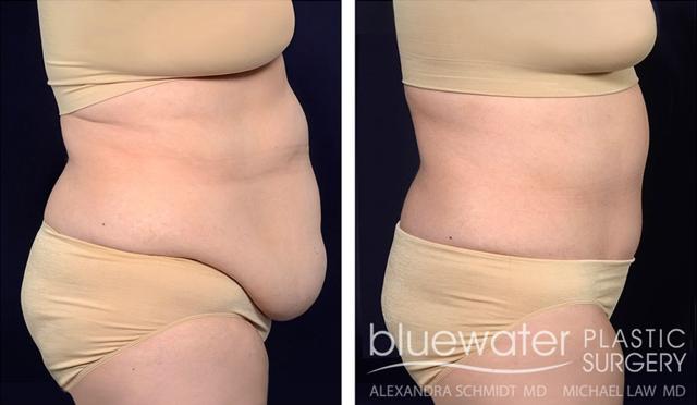Tummy Tuck result at Blue Water Plastic Surgery Partners in Raleigh, NC