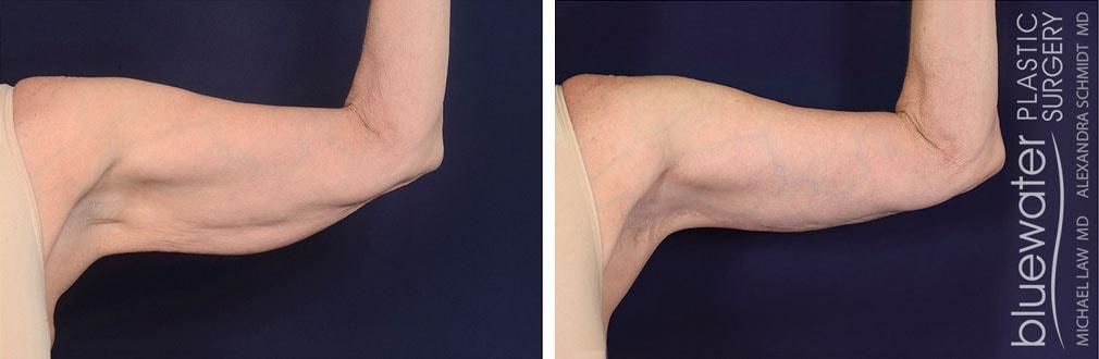 Blue Water Plastic Surgery Partners arm lift result — Raleigh, NC