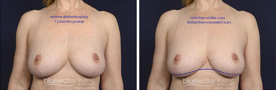 Blue Water Plastic Surgery Partners liposuction result — Raleigh, NC