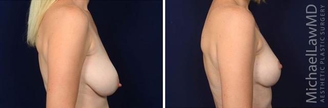 Breast Reduction result at Blue Water Plastic Surgery Partners in Raleigh, NC