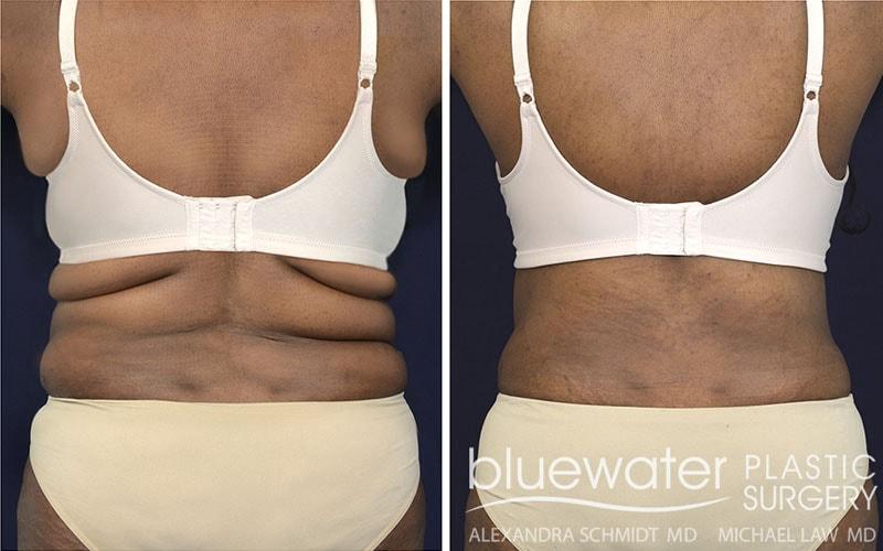 Blue Water Plastic Surgery Partners body lift result — Raleigh, NC