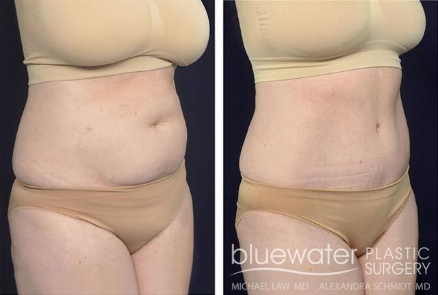 Tummy Tuck result at Blue Water Plastic Surgery Partners in Raleigh, NC