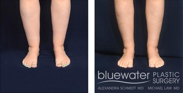 Liposuction result at Blue Water Plastic Surgery Partners in Raleigh, NC