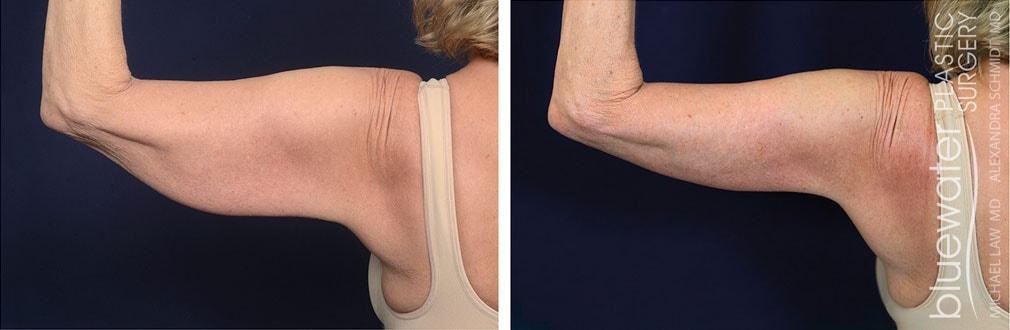 Blue Water Plastic Surgery Partners arm lift result — Raleigh, NC