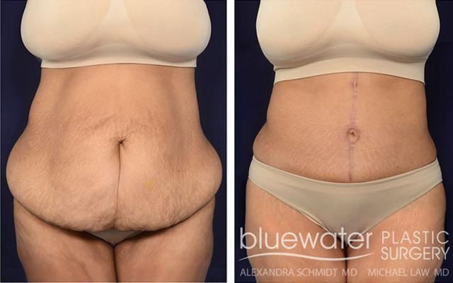 Tummy Tuck result at Blue Water Plastic Surgery Partners in Raleigh, NC