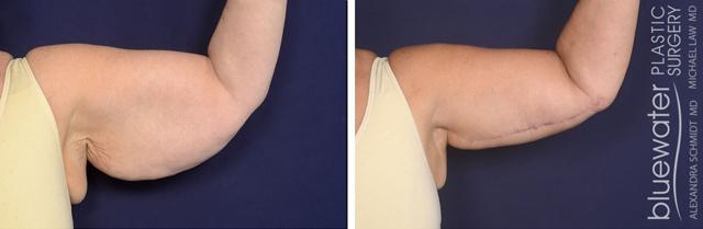 Arm Lift result at Blue Water Plastic Surgery Partners in Raleigh, NC